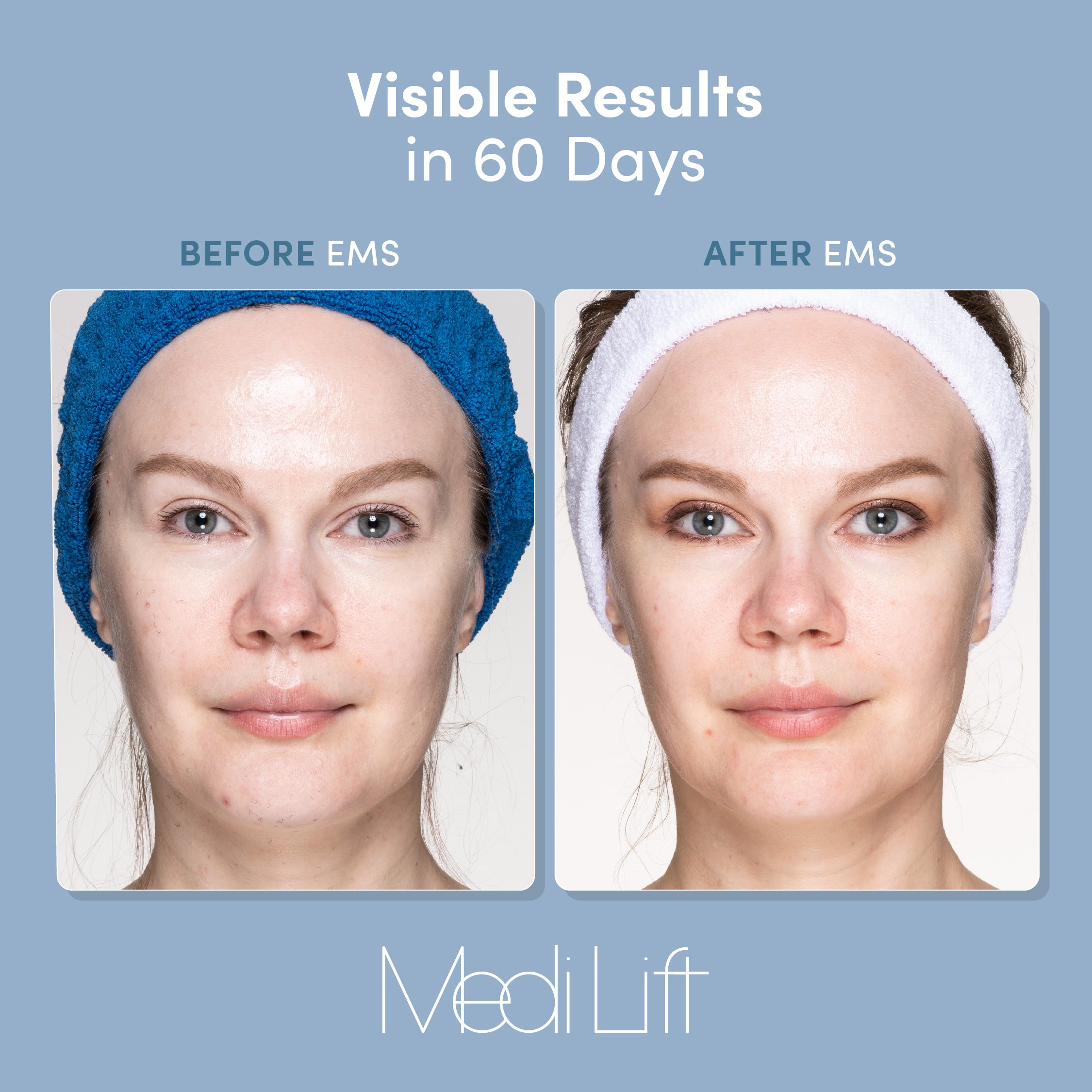 Anatomy of a Micro-Spicule, the Latest Skincare Star – Medi Lift Beauty